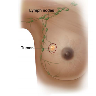 The dotted line shows where the  tumor is removed. Lumpectomy is  the removal of abnormal cells or  tumor and not the whole breast.