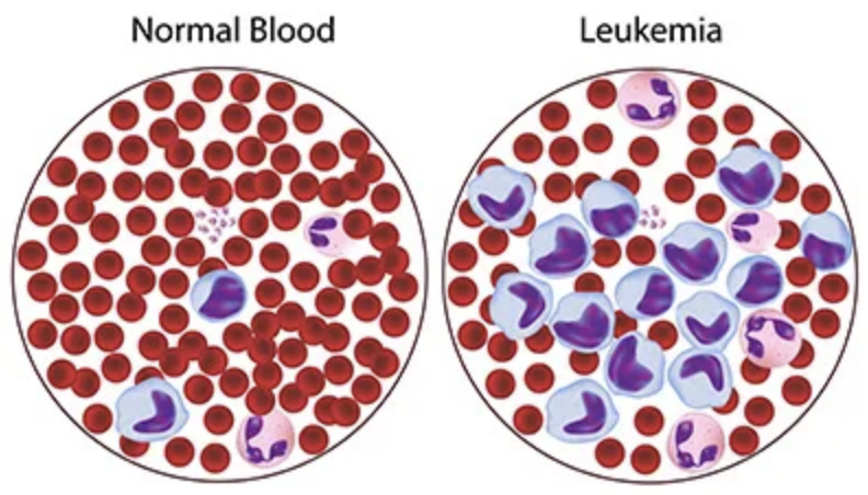 2. Blood Cancers