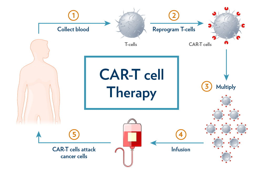 CAR-T therapy