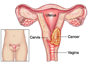 Cervical cancer