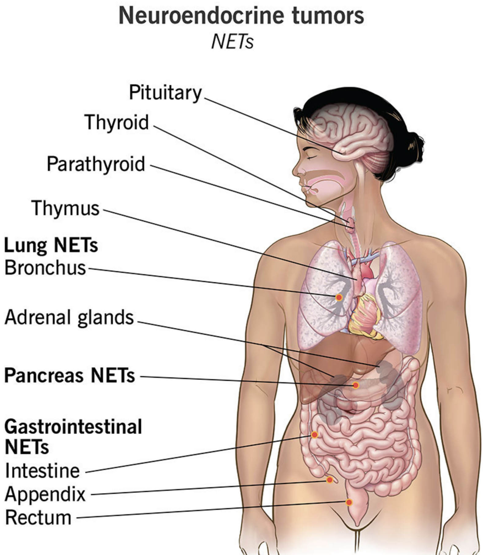 Neuroendocrine Tumor