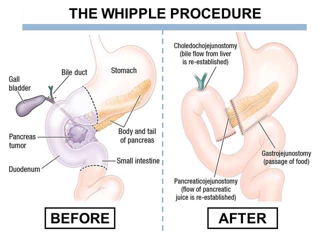 Pancreas Surgery